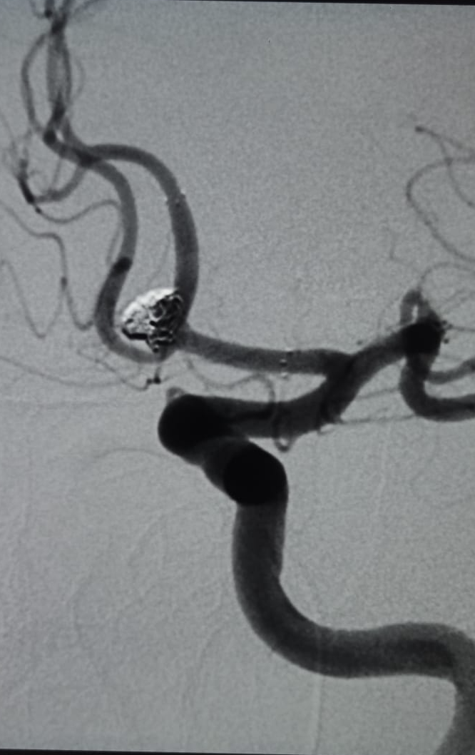 Control angiogram after endovascular coiling of an anterior communicating artery aneurysm, Neurospine International, September 2026