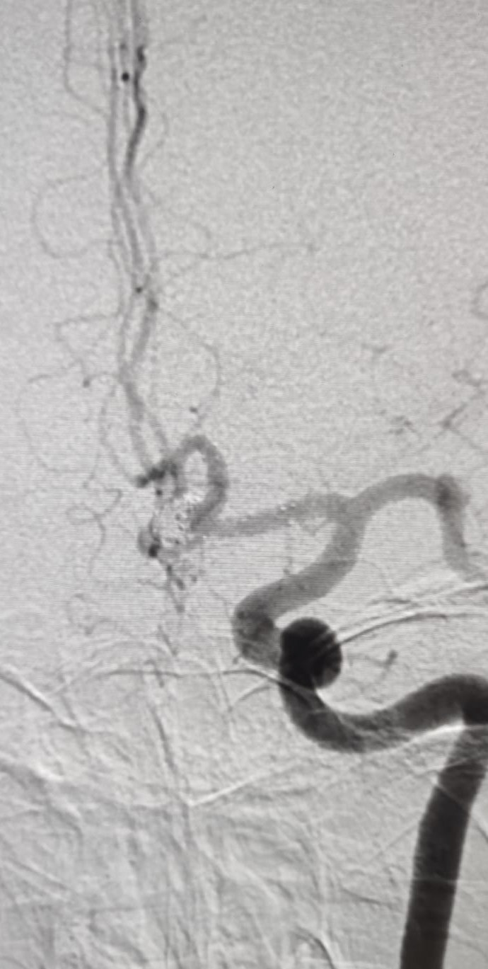 Second angiographic view after coiling of an anterior communicating artery aneurysm, Neurospine International, September 2026