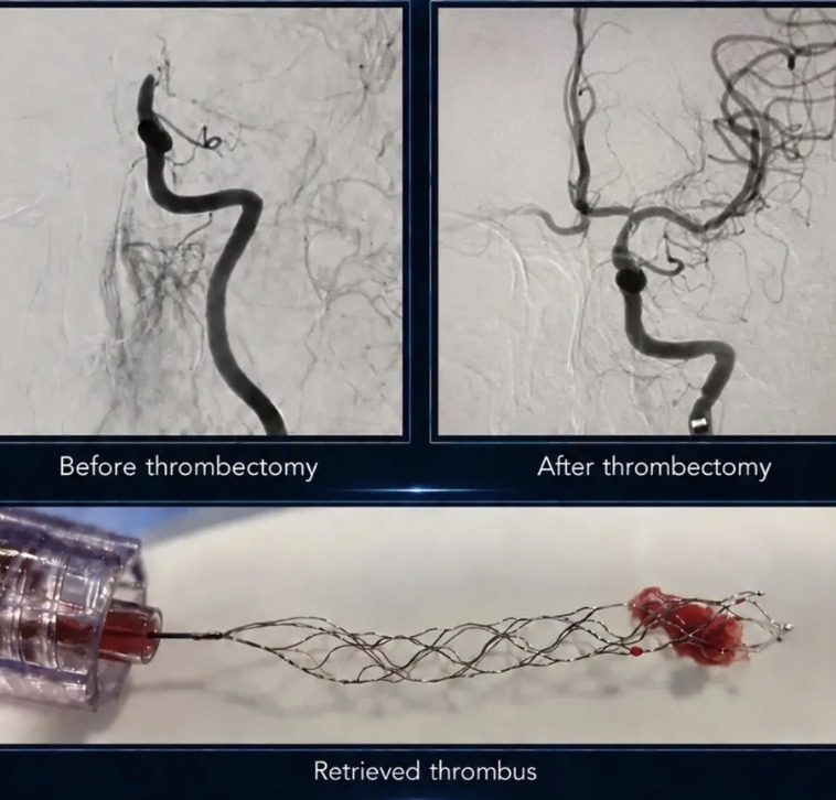 Angiograms before and after mechanical thrombectomy for acute ischaemic stroke, with the retrieved thrombus in a stent retriever, Neurospine International, September 2026