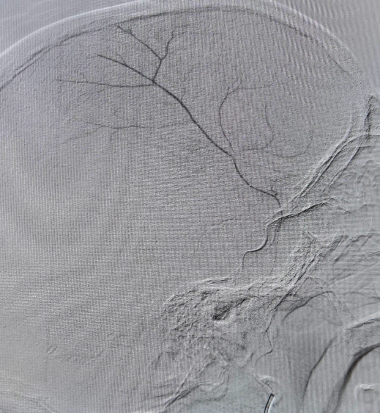 Angiogram of the middle meningeal artery during embolization for chronic subdural haematoma, Neurospine International, September 2026