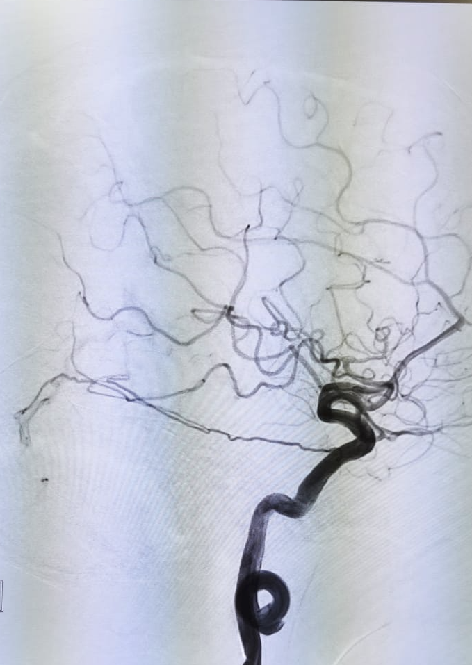 Cerebral angiogram from a high-risk tentorial dural arteriovenous fistula treated by endovascular embolization, Neurospine International, September 2026