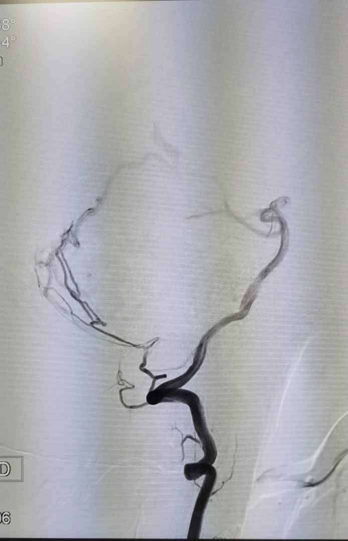 Second angiographic view of a tentorial dural arteriovenous fistula embolization, Neurospine International, September 2026